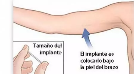 El implante hormonal, o “chip”, que evita un embarazo